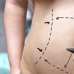 What Are CoolSculpting and SculpSure, and Do They Actually Work?