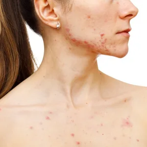 Important Updates to AAD's Acne Guidelines