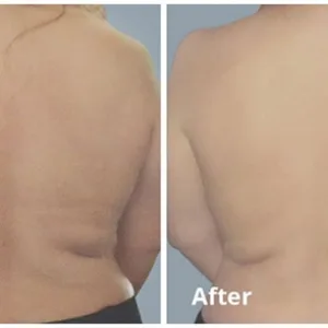 InMode Aesthetic Solutions Receives FDA Clearance for the New BodyFX Device