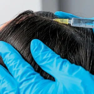 Hair Transplant Trends