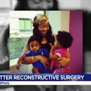 Better Reconstructive Surgery