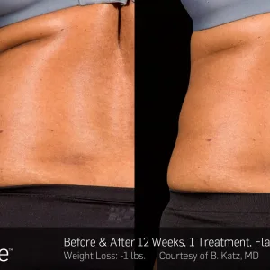 SculpSure OKed for Back, Inner and Outer Thighs