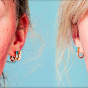 Acne and Rosacea