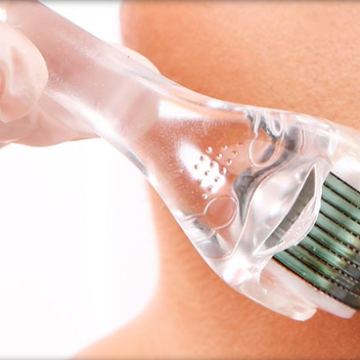 Microneedling