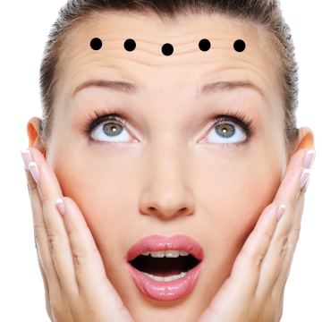 Botox injection sites Forehe