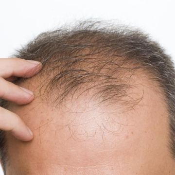A man experiencing hair loss