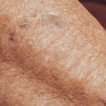 Amspa aging skin 103025