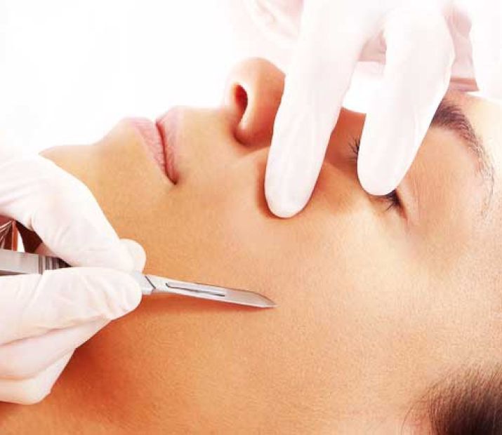 Dermaplaning