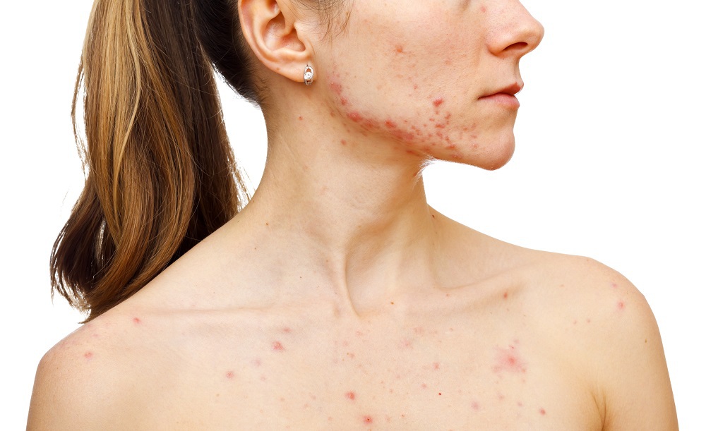Acne on face and chest