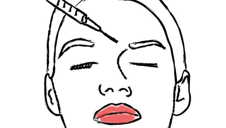 Botox glabellar injection (drawn)